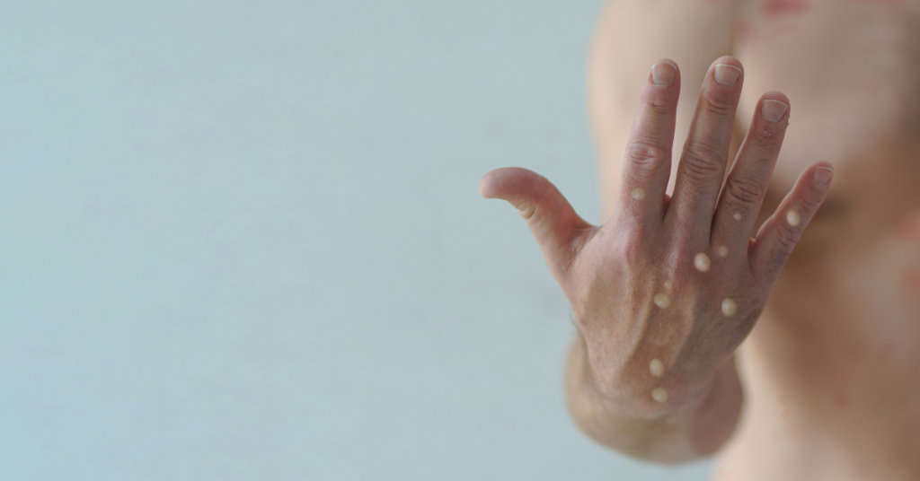 picture of man's hand and chest with monkeypox